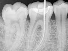 endodoncia