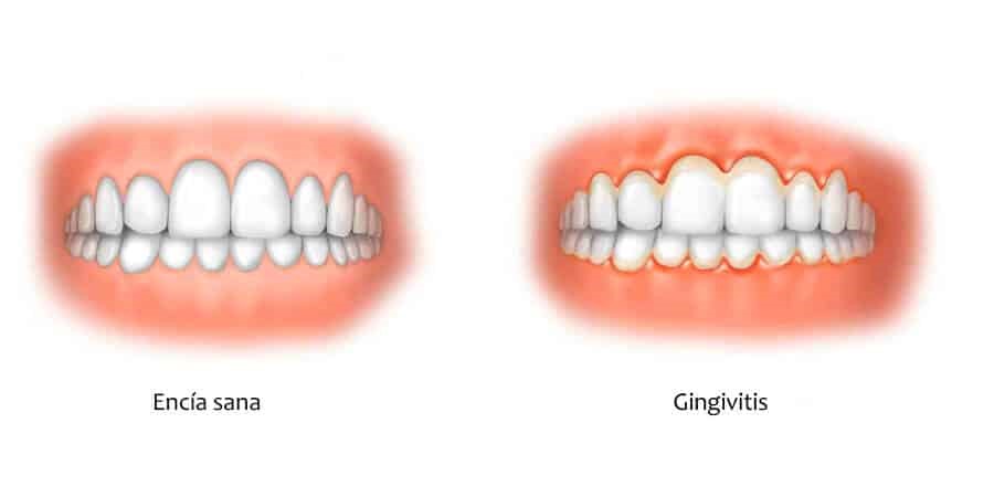 gingivitis1