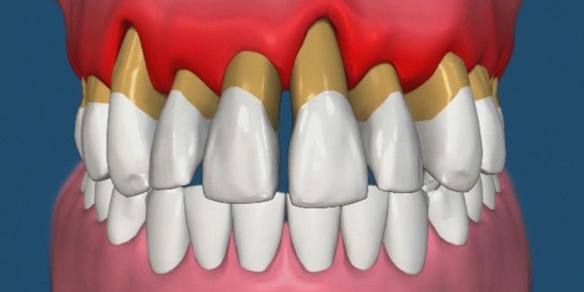 gingivitis3