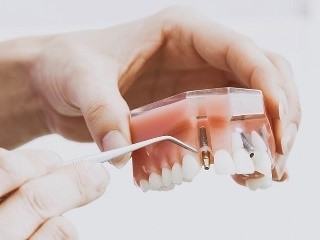 Implante Dental