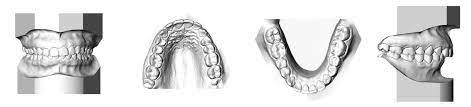 brackets3