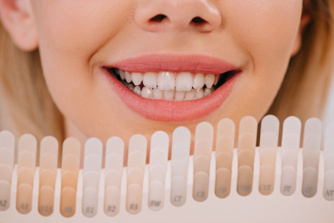 Comparativa de color entre tipos de carillas dentales