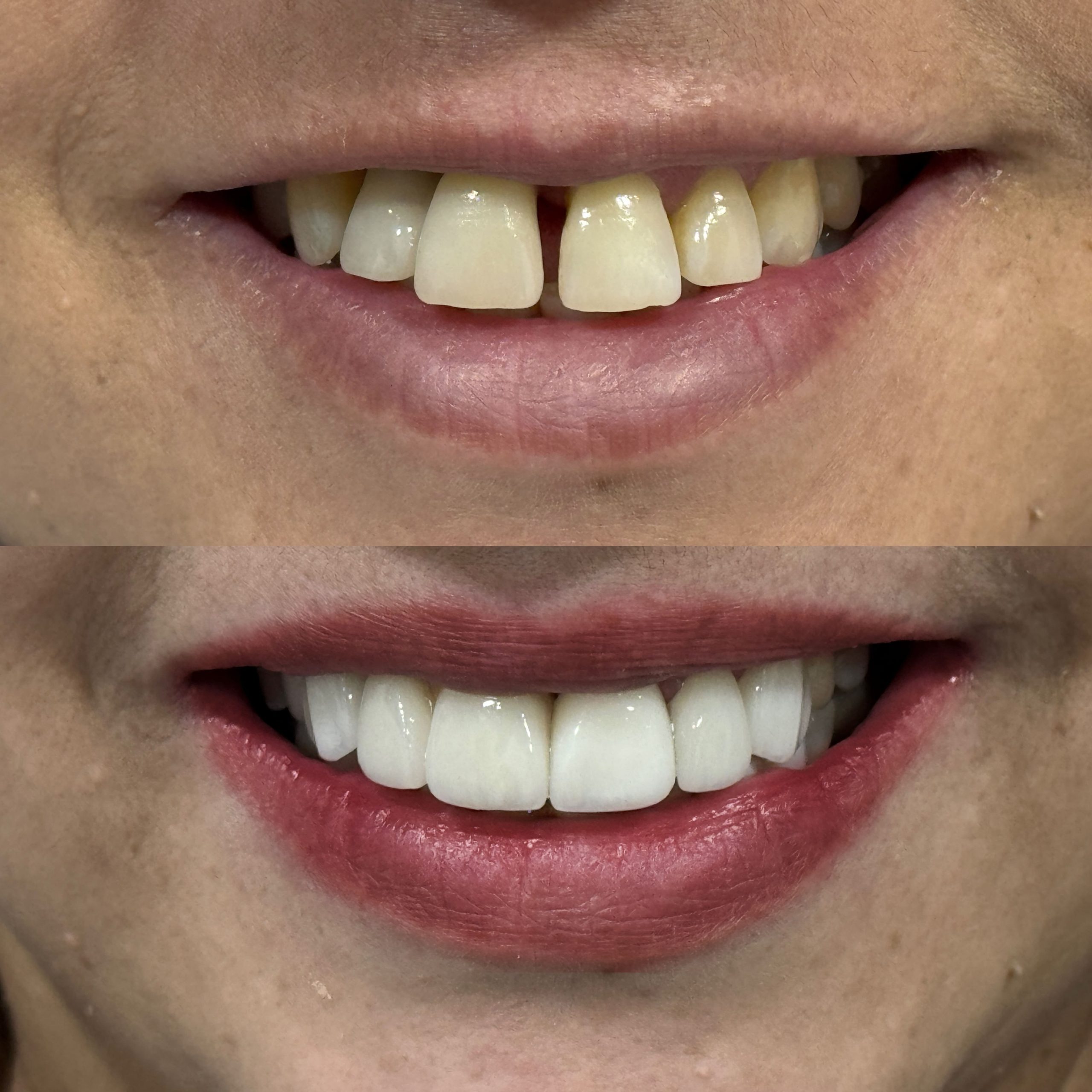 Carillas dentales en Madrid para una sonrisa perfecta