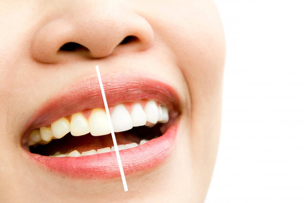 ¿Qué es el blanqueamiento dental?