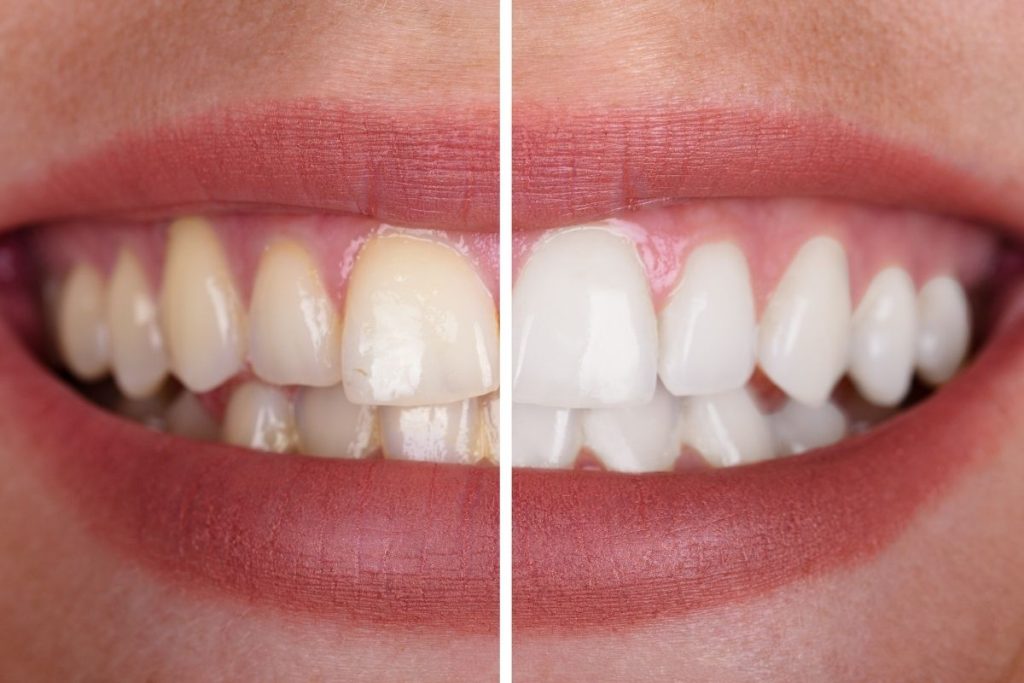 ¿Qué hacer para que no duela un blanqueamiento dental? 7 consejos