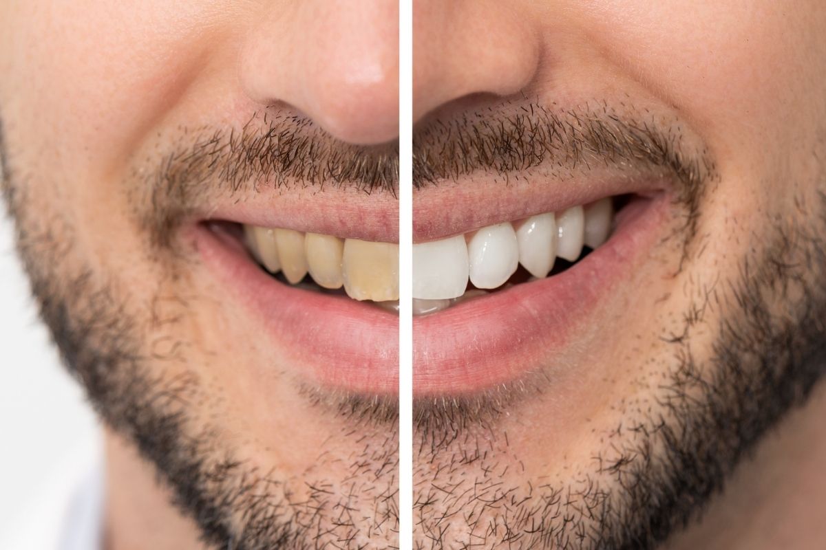 Cómo blanquear los dientes amarillos en 2 minutos: remedios paso a paso