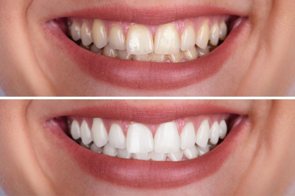 Remedios caseros para blanquear dientes amarillentos