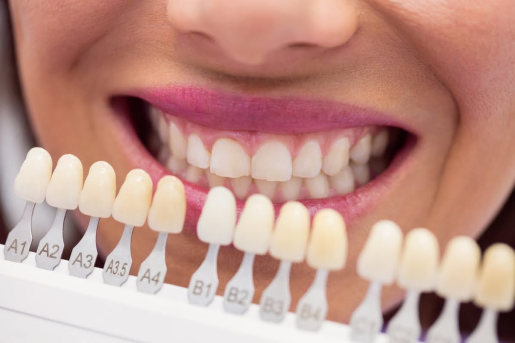 Tipos de materiales para tus facetas dentales en Habana 77