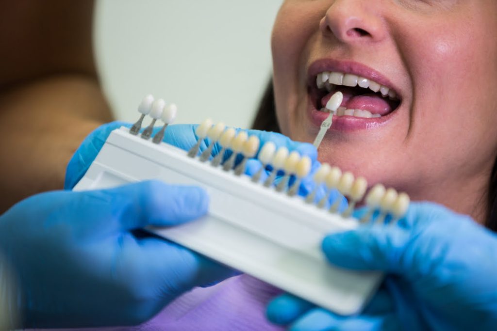 Cómo se colocan las carillas dentales según el tipo de material