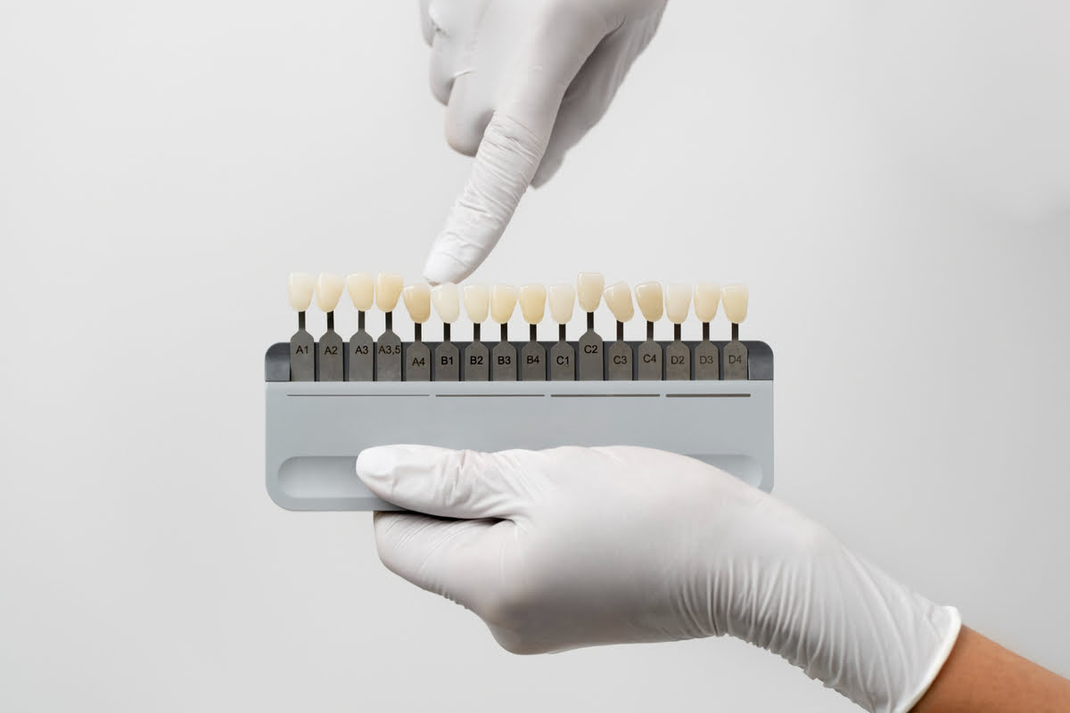 ¿Cómo se pone una carilla dental? Estos son los pasos que sigue el tratamiento