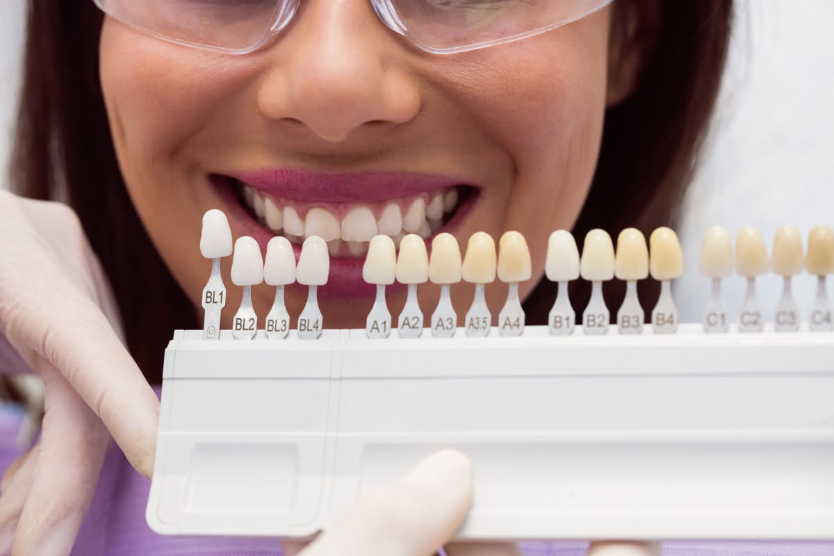 ¿Cuánto cuestan las carillas dentales en Madrid este 2026?