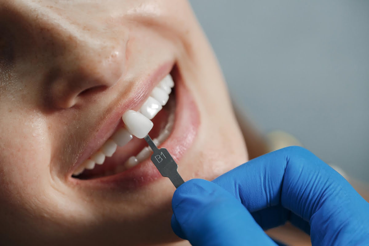 ¿Qué son las carillas dentales? Guía completa para una sonrisa perfecta