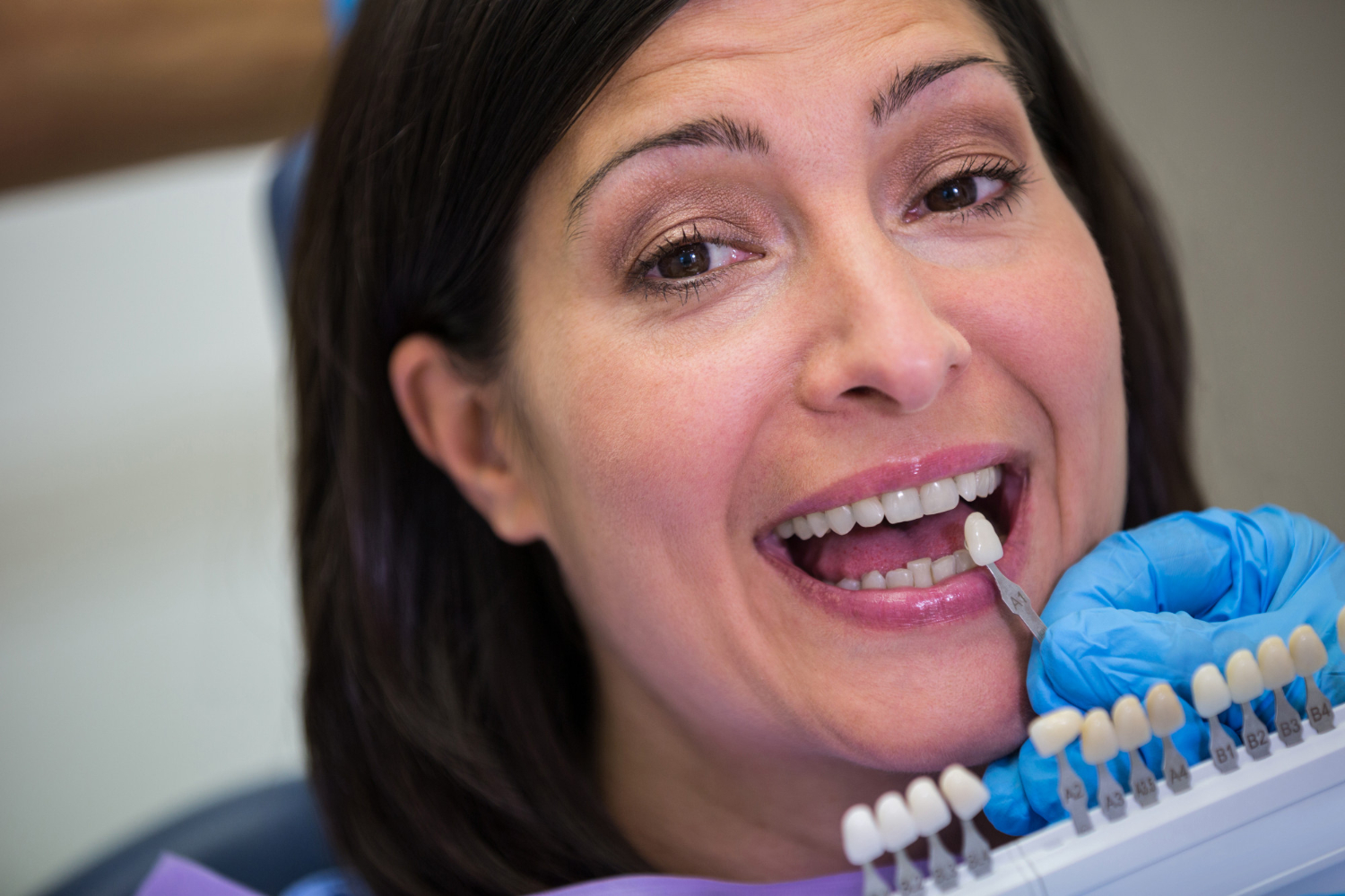 Requisitos para ponerse carillas dentales ¿eres el candidato ideal?
