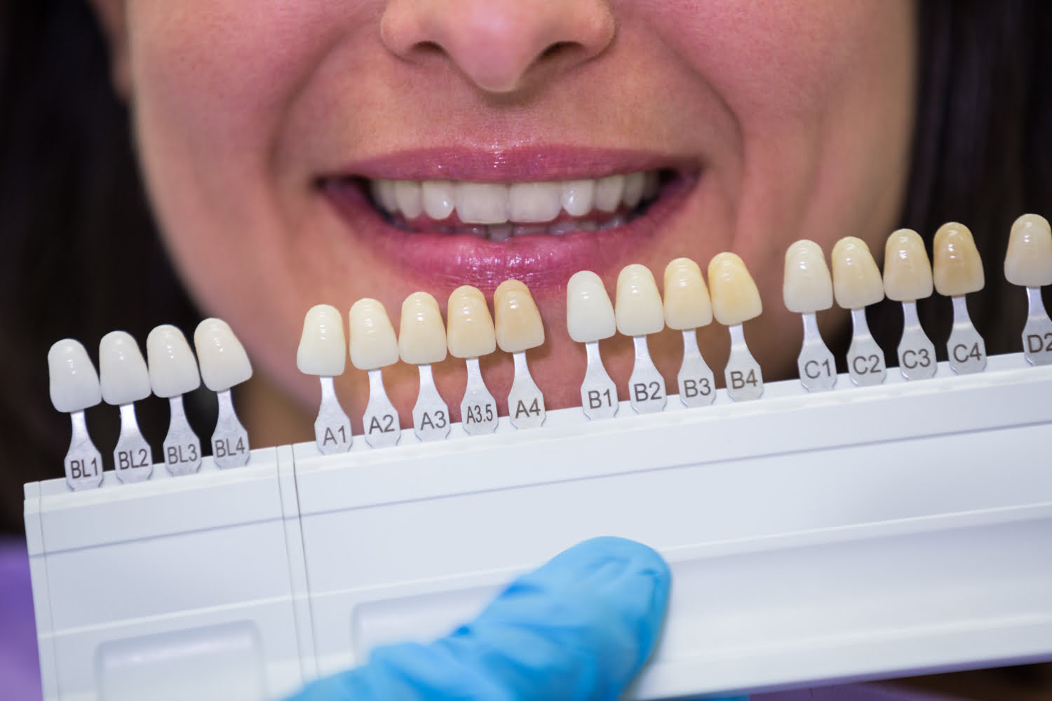 Carillas dentales: El proceso de colocación paso a paso
