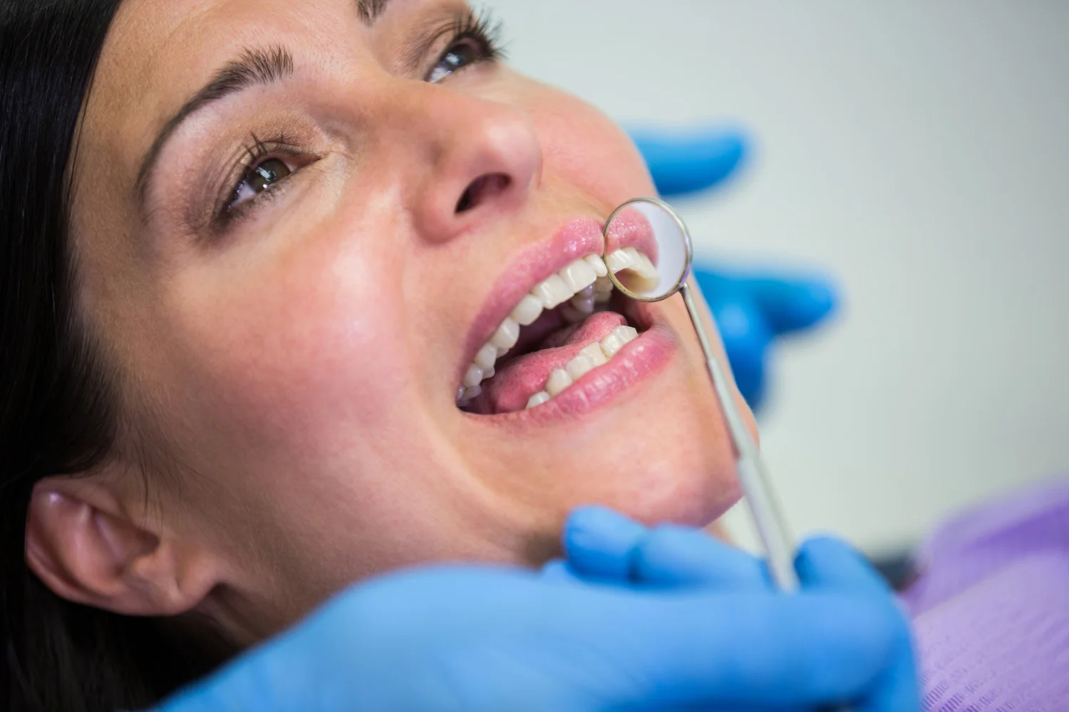 Carillas E-Max ¿qué ventajas ofrece el disilicato de litio para tu sonrisa?